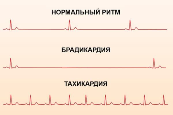 Норма пульсу у жінок – стандартні показники та особливості