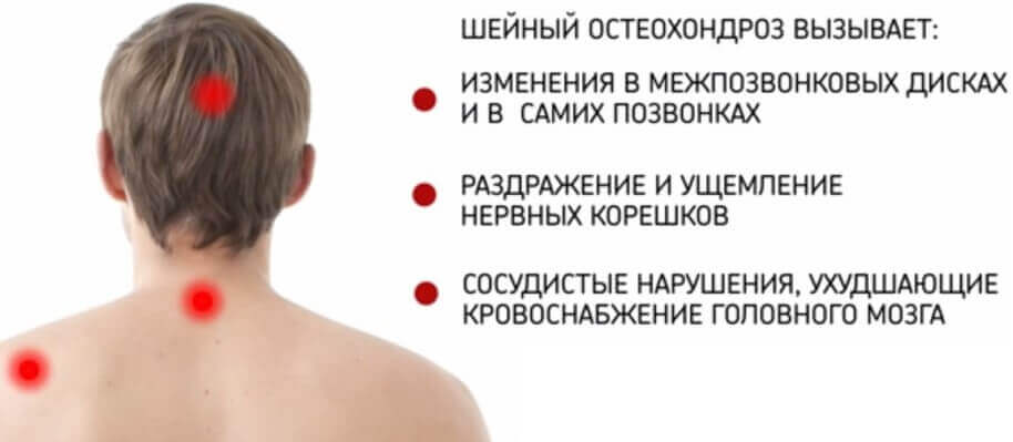 Шийний остеохондроз і артеріальний тиск