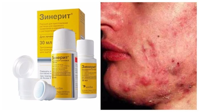 Зинерит от прыщей: инструкция по применению