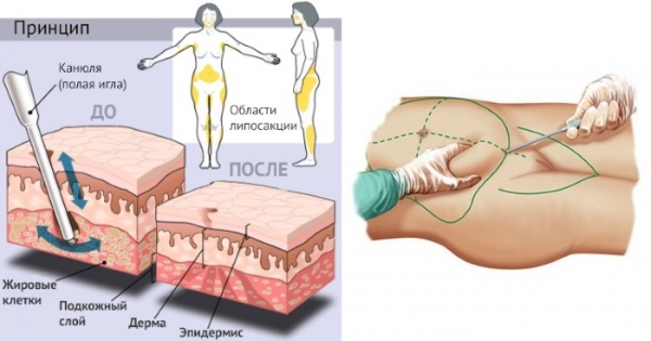 Як зробити талію тонше і прибрати живіт. Обгортання, вправи, фитосборы19