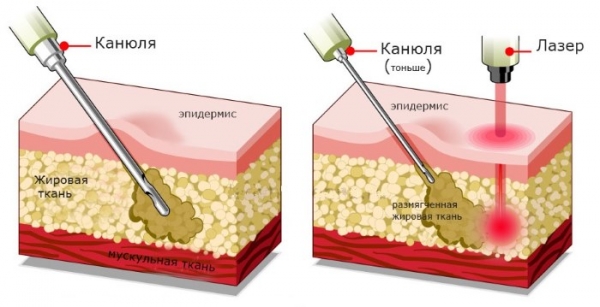 Як зробити талію тонше і прибрати живіт. Обгортання, вправи, фитосборы21