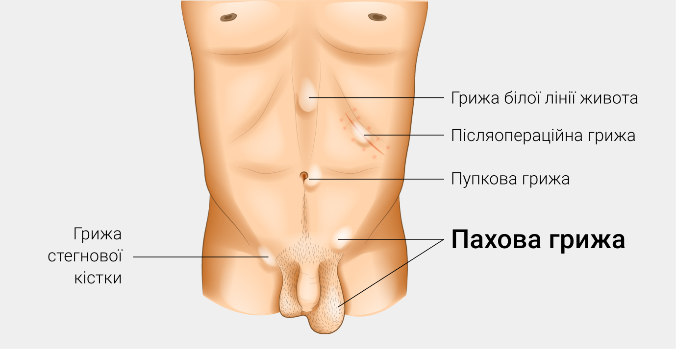 Паховая грыжа